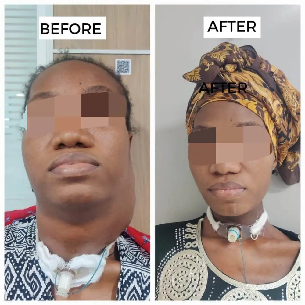 A Medical Triumph: Nigerian Woman's Massive Neck Tumor Removed in a Landmark Surgery